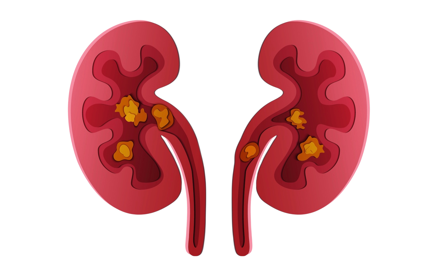 Tulane Kidney Stone Medical illustration showing kidney stones