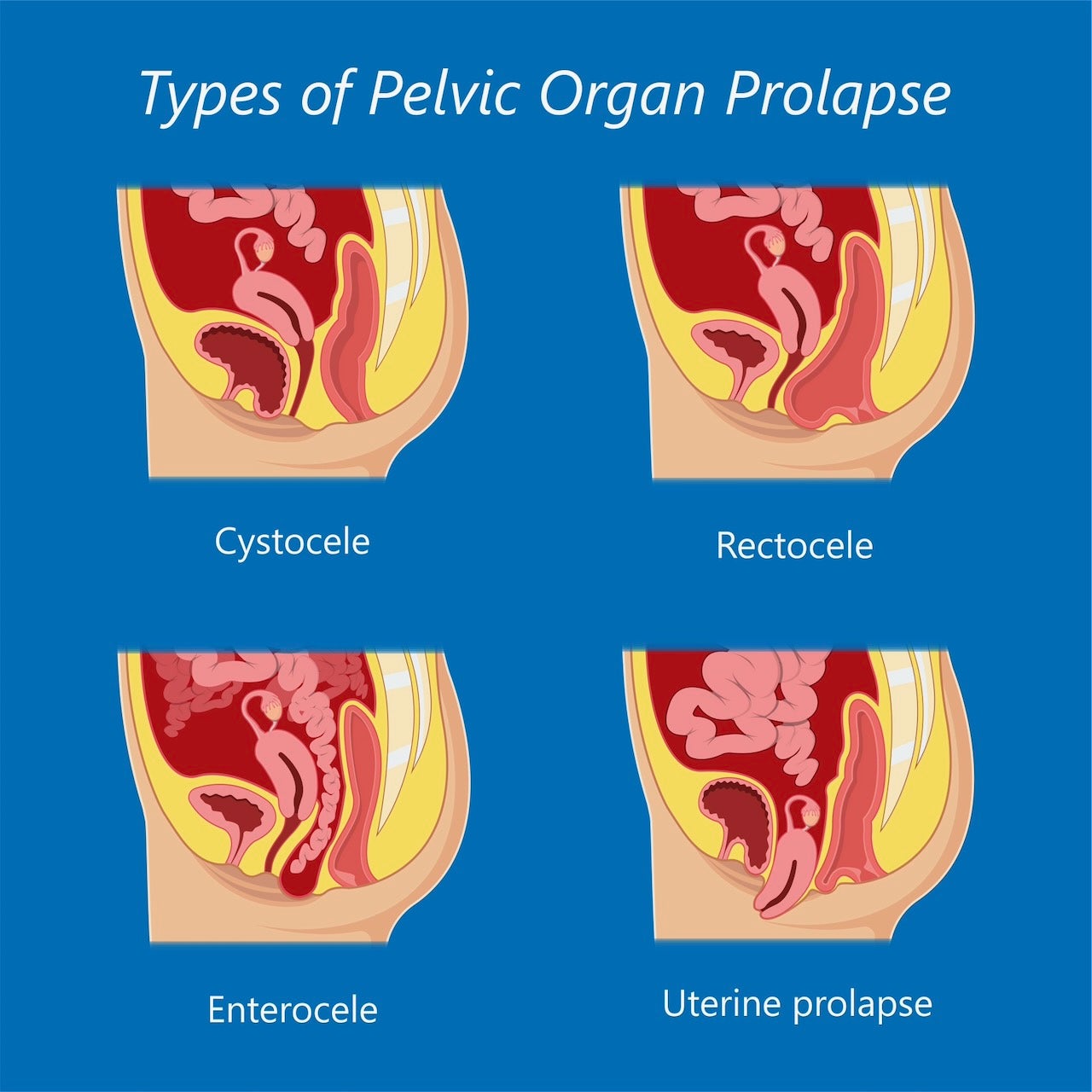 Medical illustration of pelvic organ prolapse